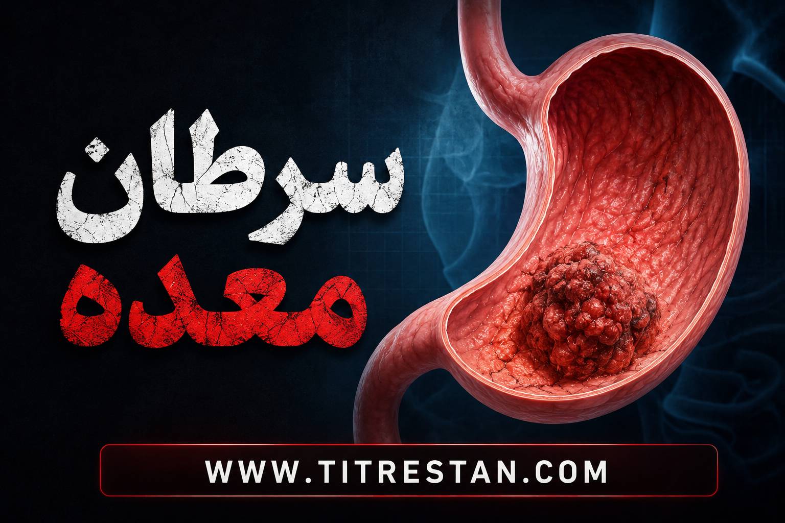 سرطان معده چیست؟ علائم، عوامل خطر و روشهای تشخیص و درمان