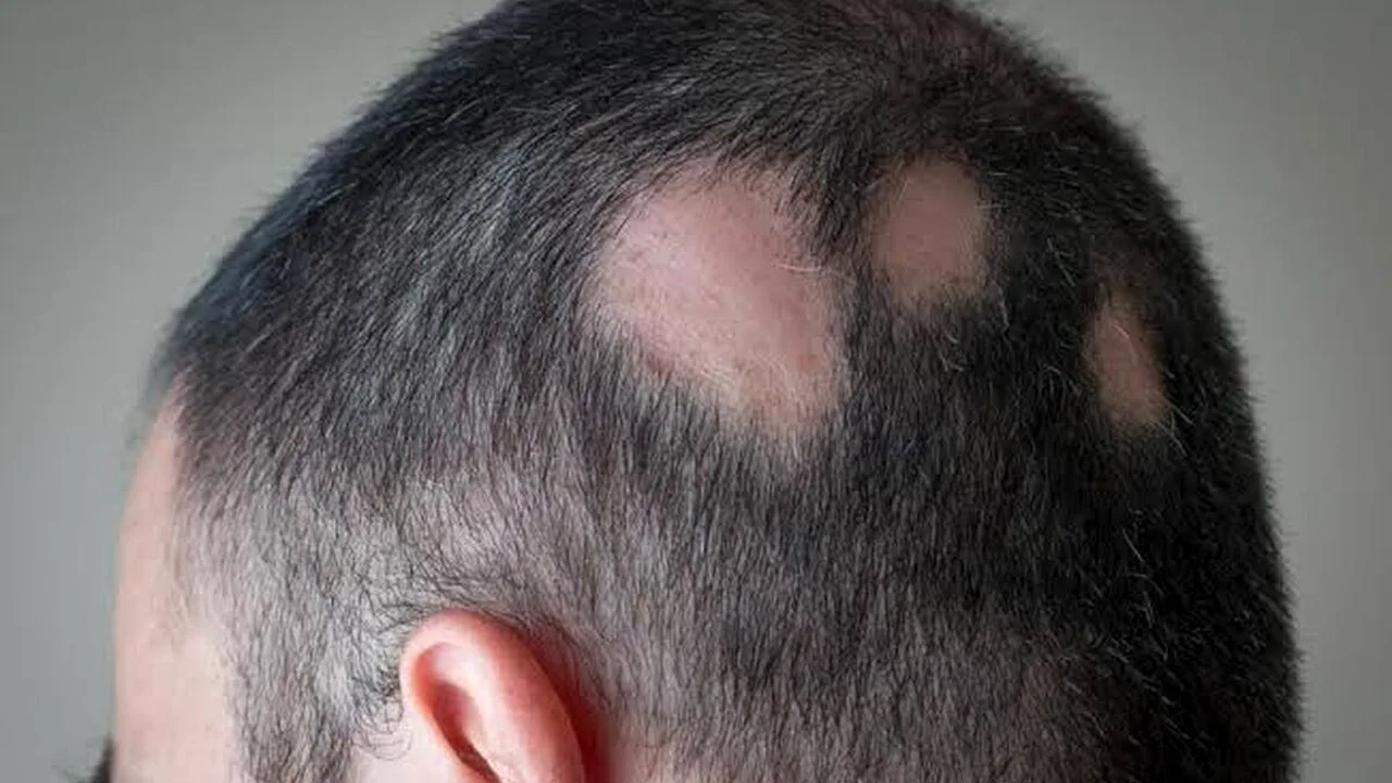 آلوپسی آره آتا؛ وقتی سیستم ایمنی به موها حمله میکند